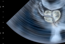 研究人員說BRCA2基因缺陷不僅是女性患癌癥的風(fēng)險