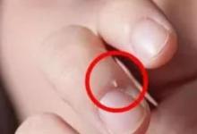 日常生活：手指上長倒刺很可能是因為什么
