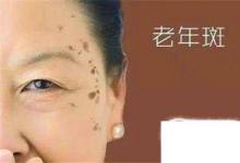 日常生活：怎樣祛除老年斑多種方法
