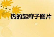 熱的起痱子圖片（熱的起痱子怎么辦）