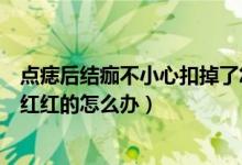 點(diǎn)痣后結(jié)痂不小心扣掉了怎么辦（點(diǎn)痣結(jié)痂后不小心摳掉了紅紅的怎么辦）