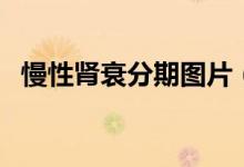 慢性腎衰分期圖片（慢性腎衰分期的標(biāo)準(zhǔn)）
