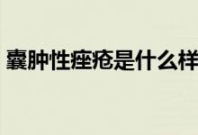 囊腫性痤瘡是什么樣（囊腫性痤瘡是什么?。?class=