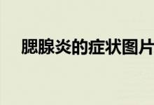 腮腺炎的癥狀圖片大全（腮腺炎的癥狀）