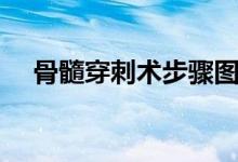 骨髓穿刺術步驟圖（骨髓穿刺術多少錢）