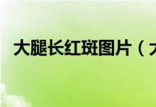 大腿長紅斑圖片(大腿內(nèi)側(cè)紅斑是梅毒嗎)