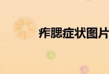 痄腮癥狀圖片（痄腮怎么治療）