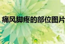 痛風(fēng)腳疼的部位圖片（痛風(fēng)常見部位是哪里）