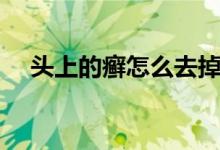 頭上的癬怎么去掉（頭上的癬怎么治療）