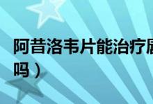 阿昔洛韋片能治療唇炎嗎（阿昔洛韋片能治疣嗎）