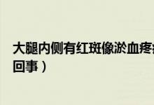 大腿內(nèi)側(cè)有紅斑像淤血疼痛（大腿內(nèi)側(cè)有紅斑像淤血是怎么回事）
