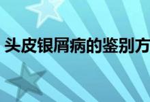 頭皮銀屑病的鑒別方法（頭皮銀屑病傳染嗎）