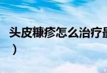 頭皮糠疹怎么治療最有效（頭皮糠疹治療方法）