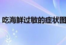 吃海鮮過(guò)敏的癥狀圖（吃海鮮過(guò)敏了怎么辦）